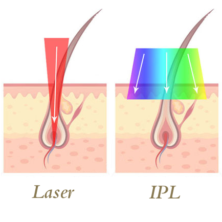 Het belangrijkste verschil tussen IPL ontharen en de Diode Ice Laser